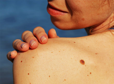 Woman examines mole on her shoulder.