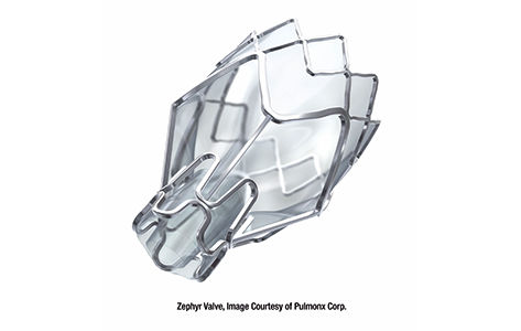 Zephyr Valve