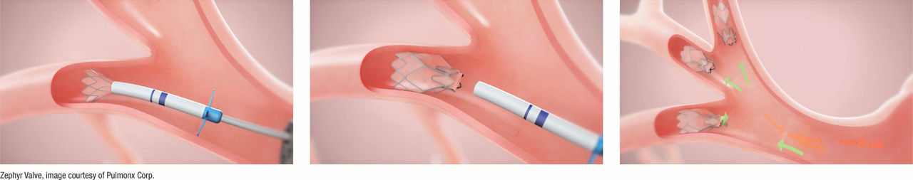 Lung Valve Demonstration