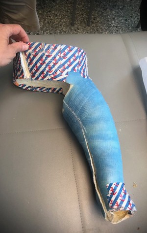 patient with abduction brace