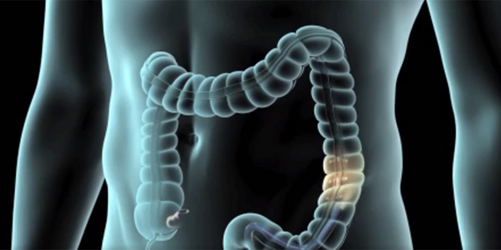 illustration of a colonoscopy