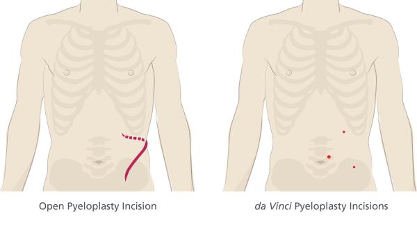 3_Incision_Comparison_Pyeloplasty_gl600w.jpg